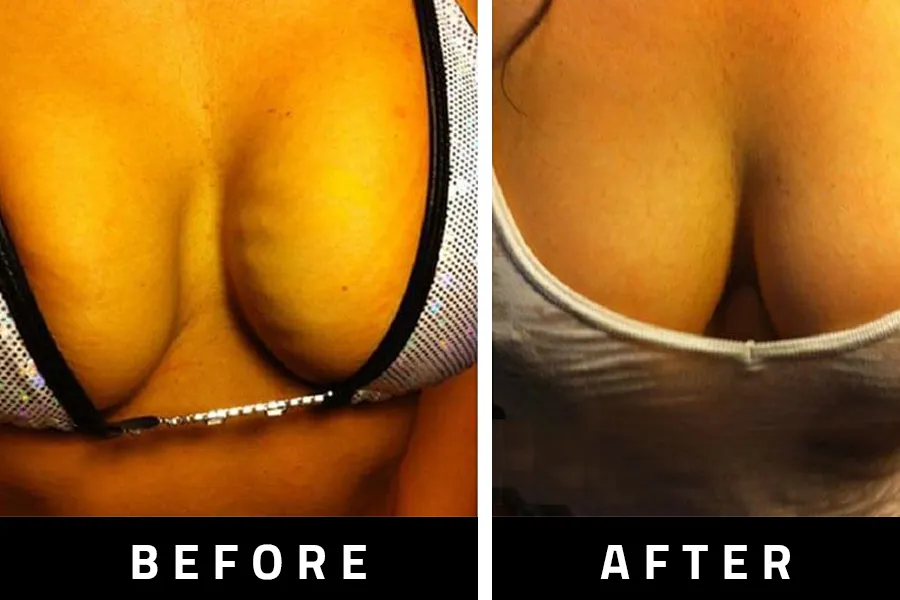 LIFT BREASTS! REVERSE SAGGING FULLER CLEAVAGE push up tits boobs