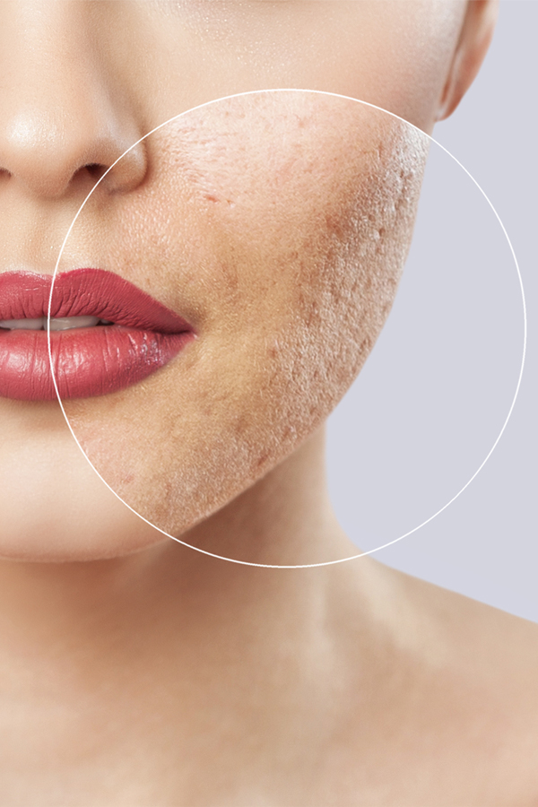 houston-texas-cosmetics-acne-and-acne-scars-treatment-specialist-camp-beauty-and-wellness Houston Texas Camp Beauty and Wellness Acne and Acne Scars Removal Service Specialist